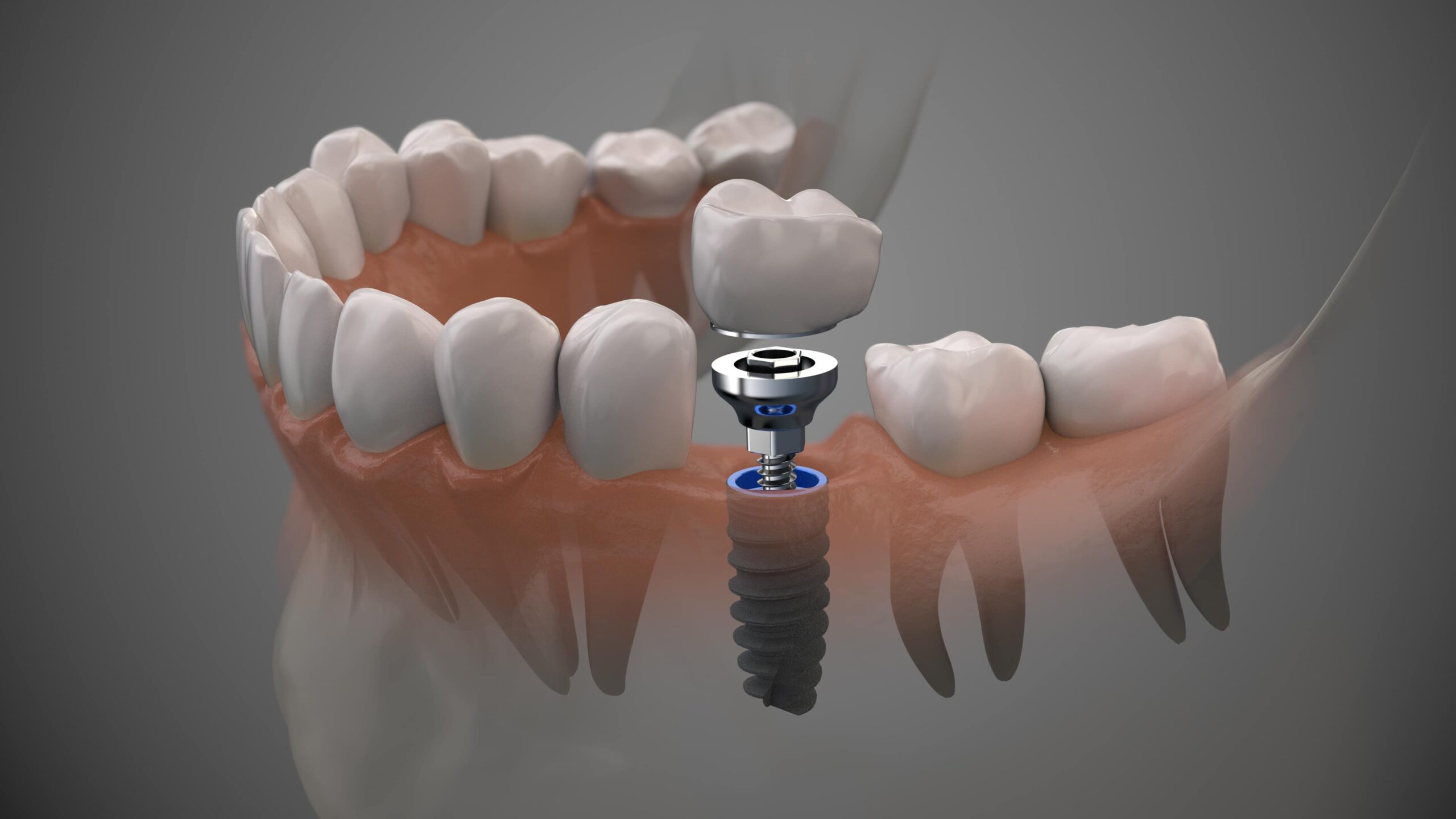 Implantes