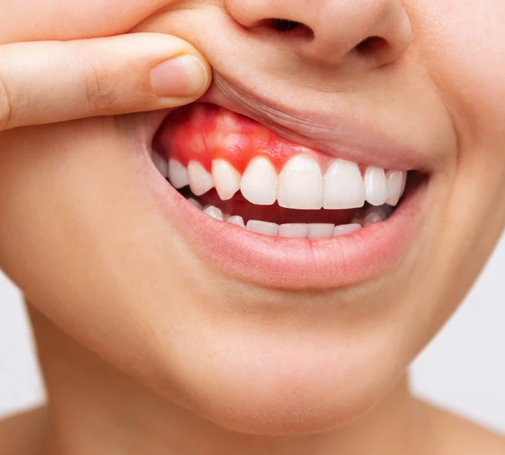 Periodoncia